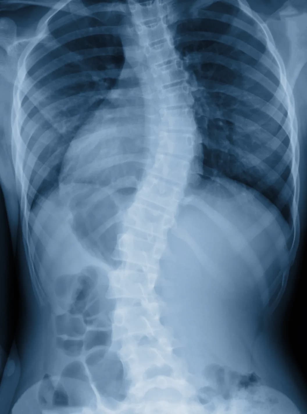 Setting the Record Straight on Idiopathic Scoliosis